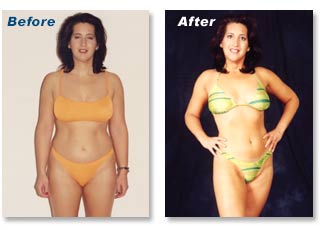 Before/After Weight Loss No. 2